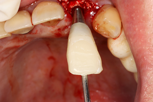 Perform final light curing, polish, and reattach intraorally.