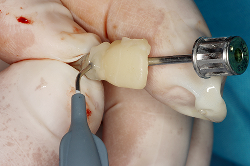 Remove it intraorally to add resin or refine the contour.