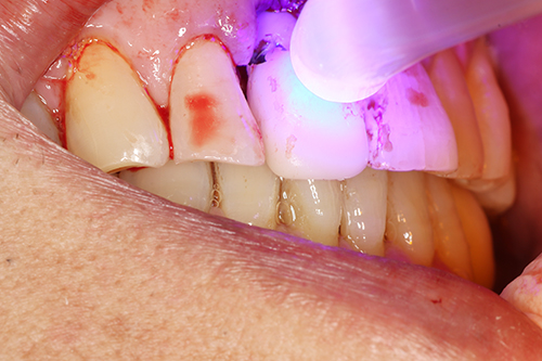 Light Curing 