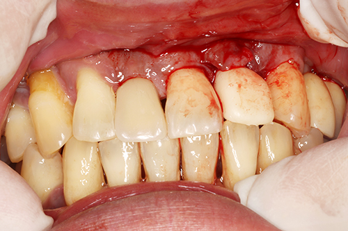 Shaping and Occlusal Adjustment