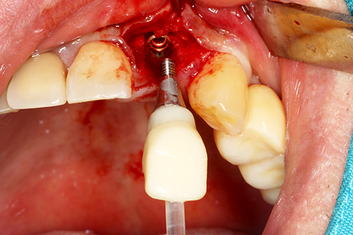 Magic i Temp provisional crown positioned on the implant site