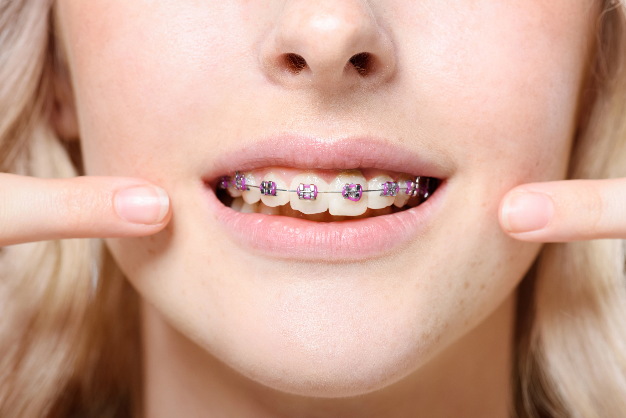 girl wearing braces from an Orthodontist in Stuart FL