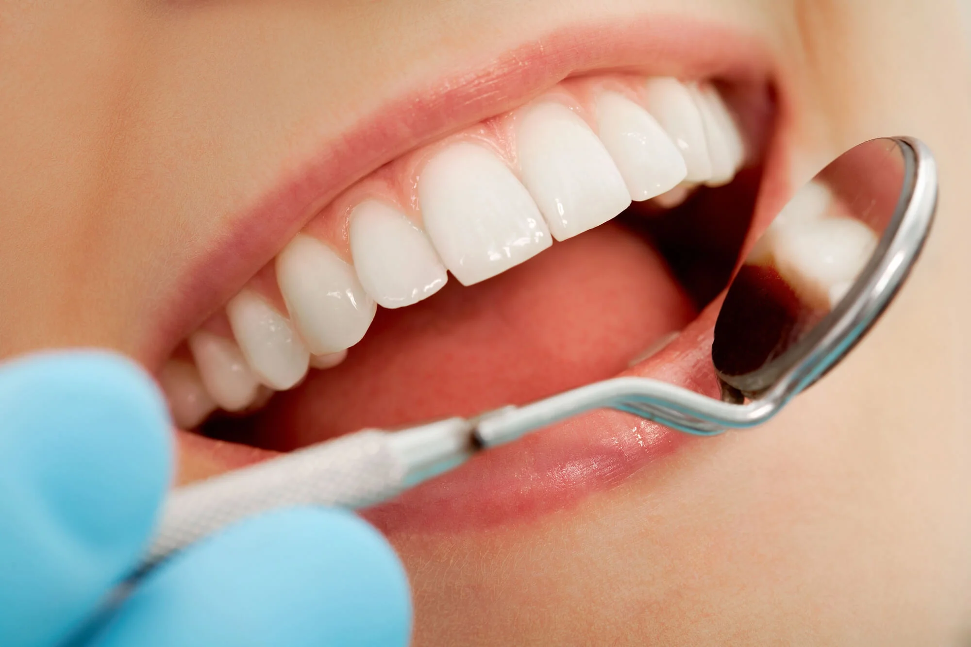 Professional dental checkup with mirror showing aligned and white teeth Cosmetic Dentist Port St Lucie