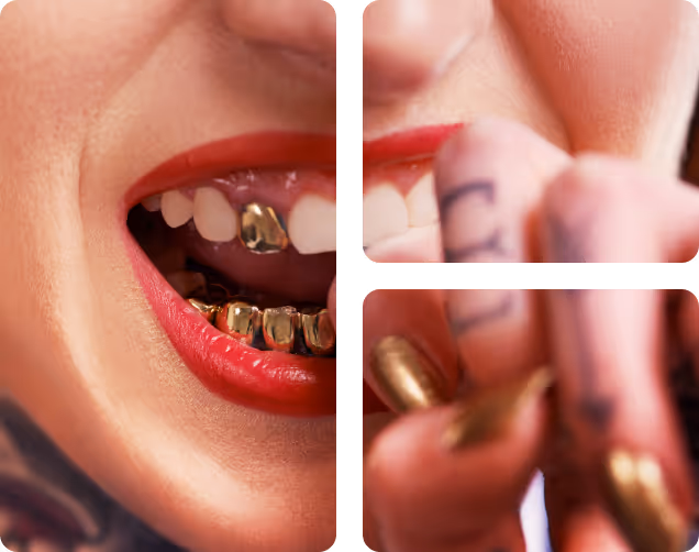 Gold Crowns benefits at Shrouf Dental House