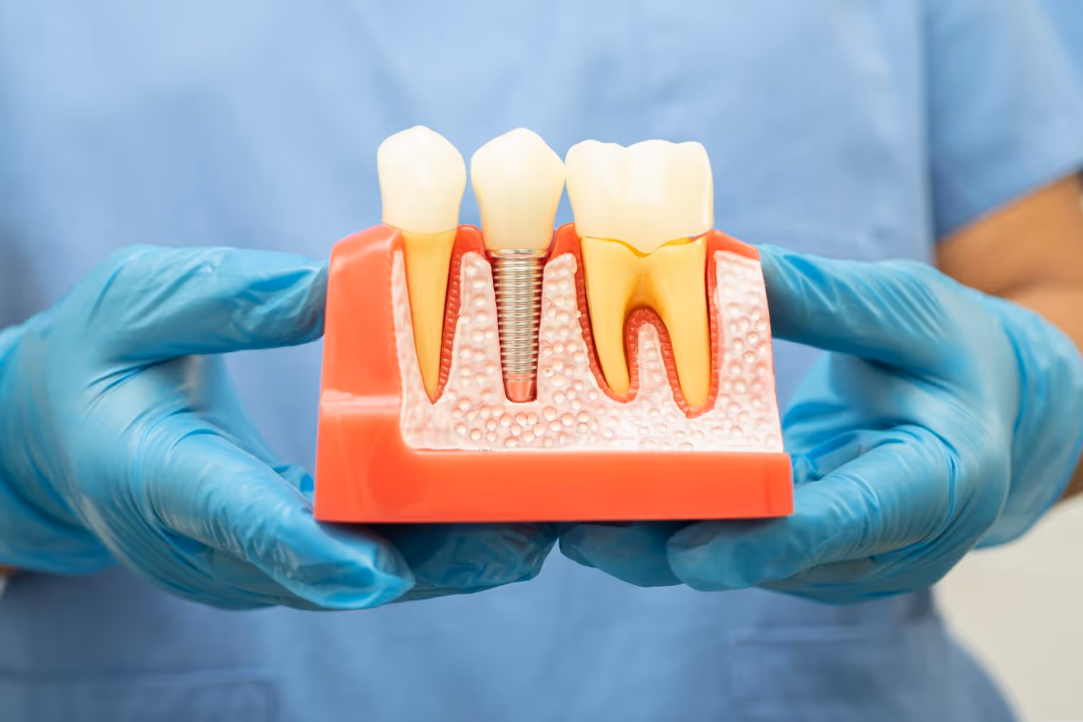 Reclaim Your Smile's Potential with Dental Implants: A Guide