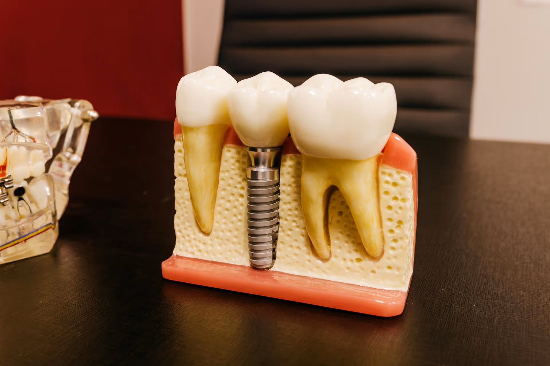 The Process of Getting Dental Implants in The Villages