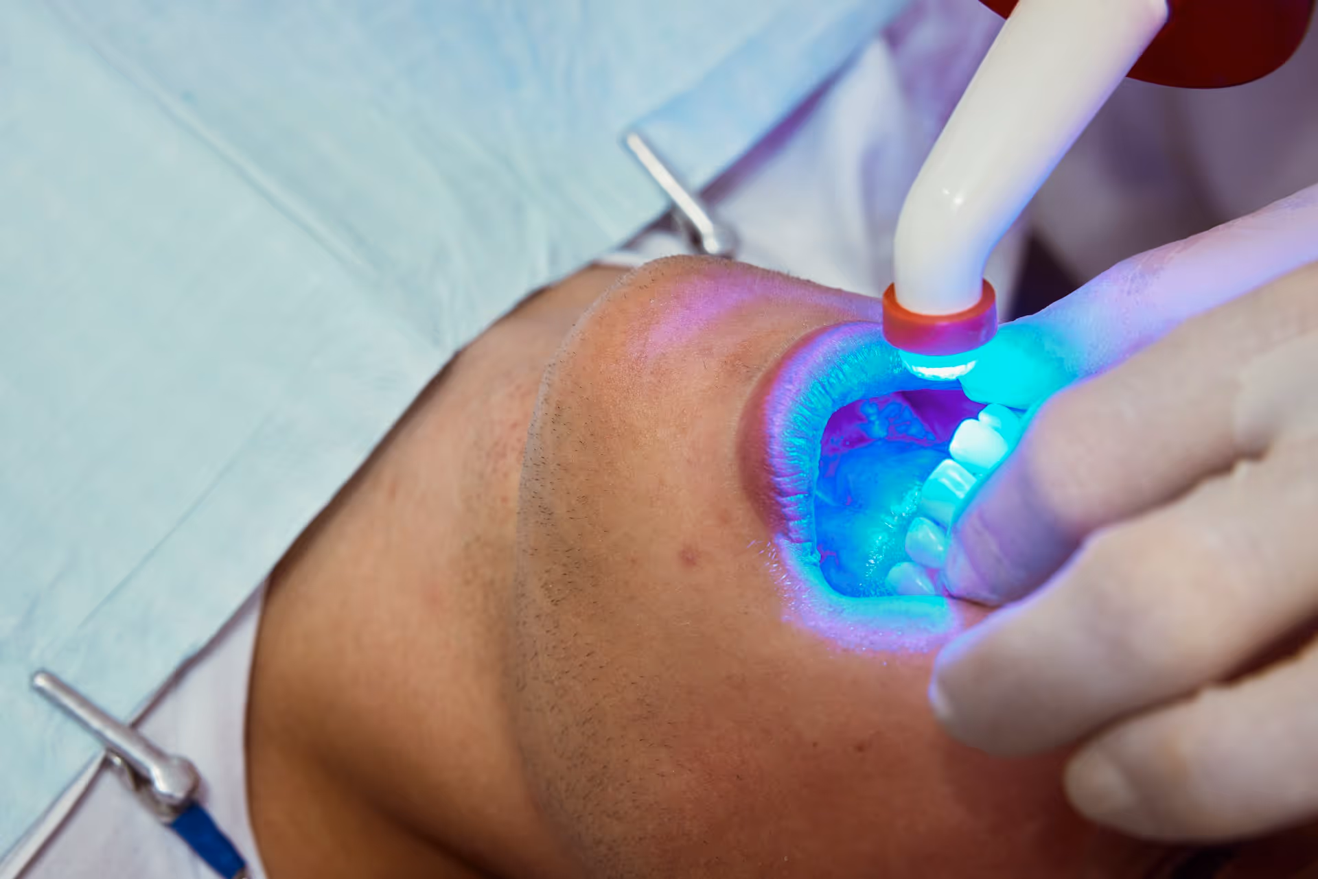 The Benefits of In-Office Teeth Whitening
