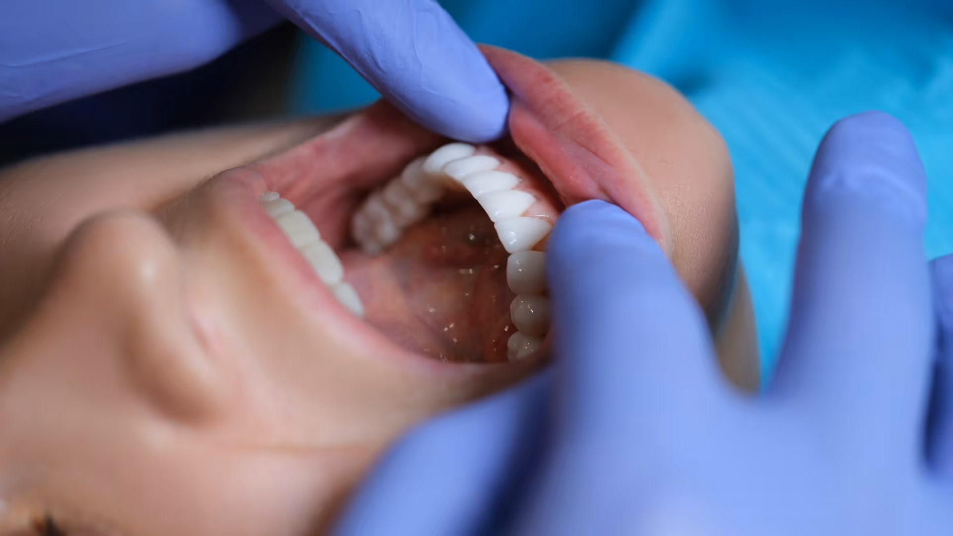 How Long Should Your Dental Fillings Last? Signs They Need Replacement