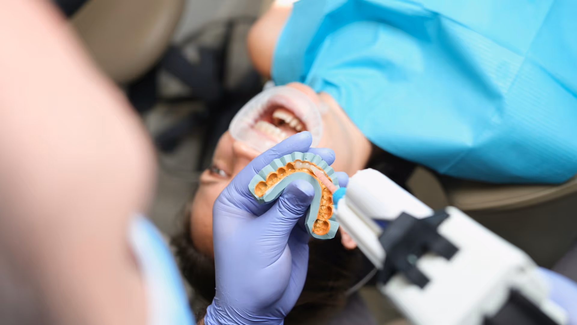 Long-lasting Effects of Veneers in The Villages