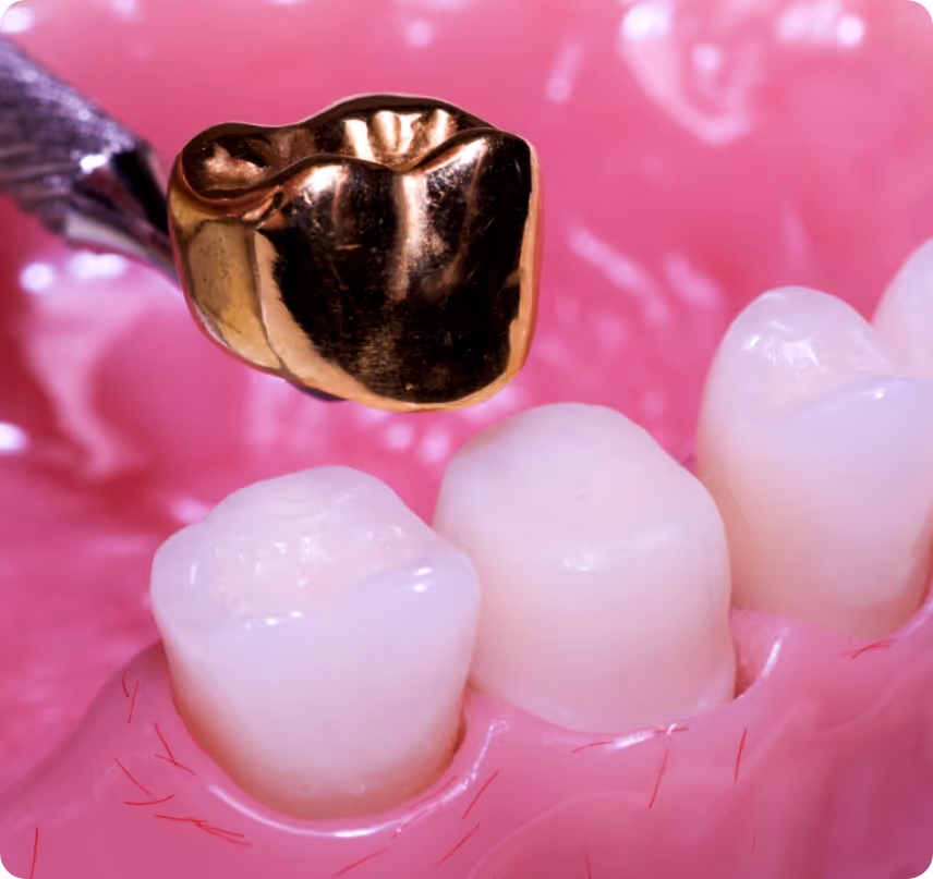 Gold Crowns benefits at Shrouf Dental House
