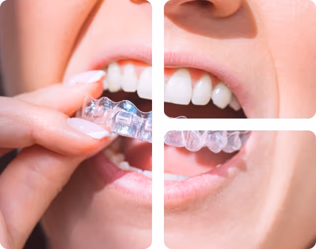 Invisalign at Shrouf Dental House