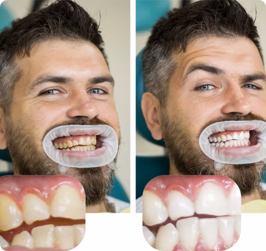 When do you need In-office Whitening at Shrouf Dental House