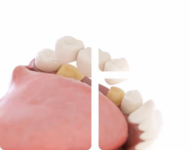 Cosmetic Bridges benefits at Shrouf Dental House