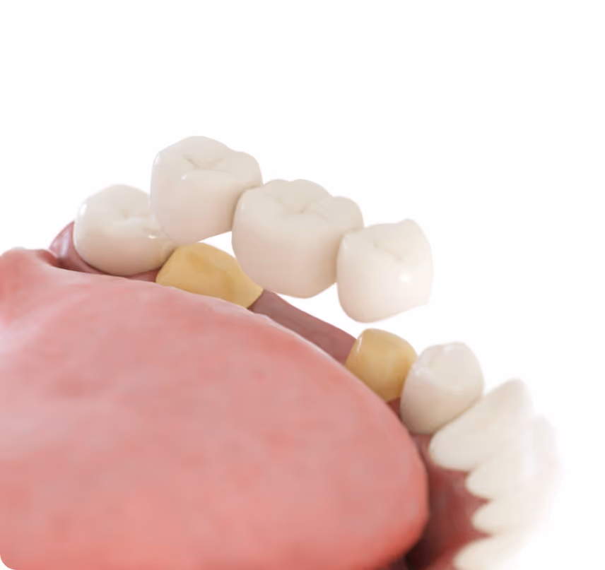 Cosmetic Bridges benefits at Shrouf Dental House