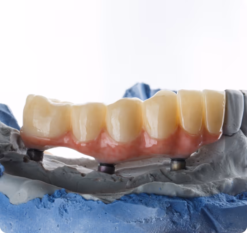 When do you need Cosmetic Bridges at Shrouf Dental House