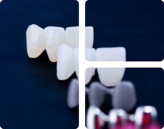 Cosmetic Crowns benefits at Shrouf Dental House