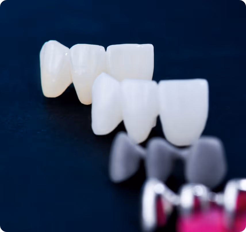 Cosmetic Crowns benefits at Shrouf Dental House