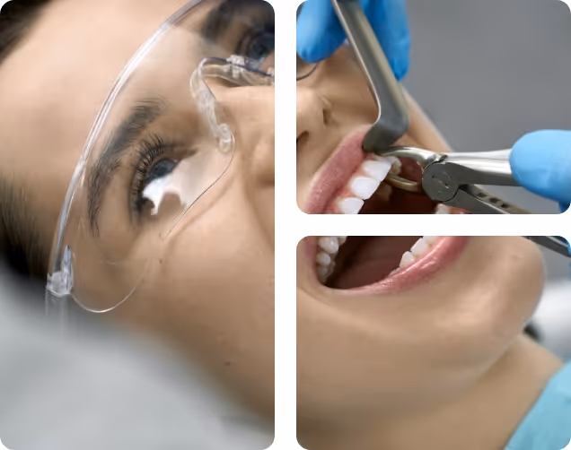 Tooth Extraction at Shrouf Dental House