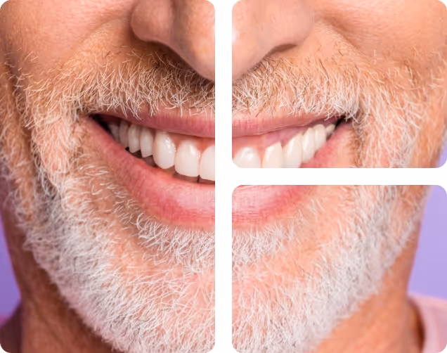 Fixed Full Mouth Implants at Shrouf Dental House