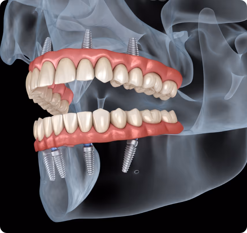 When do you need Implant Supported Dentures at Shrouf Dental House