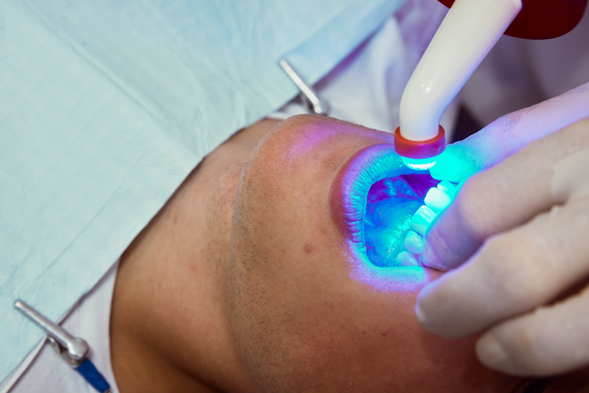 Summer Smile Refresh with in-Office Teeth Whitening in the Villages