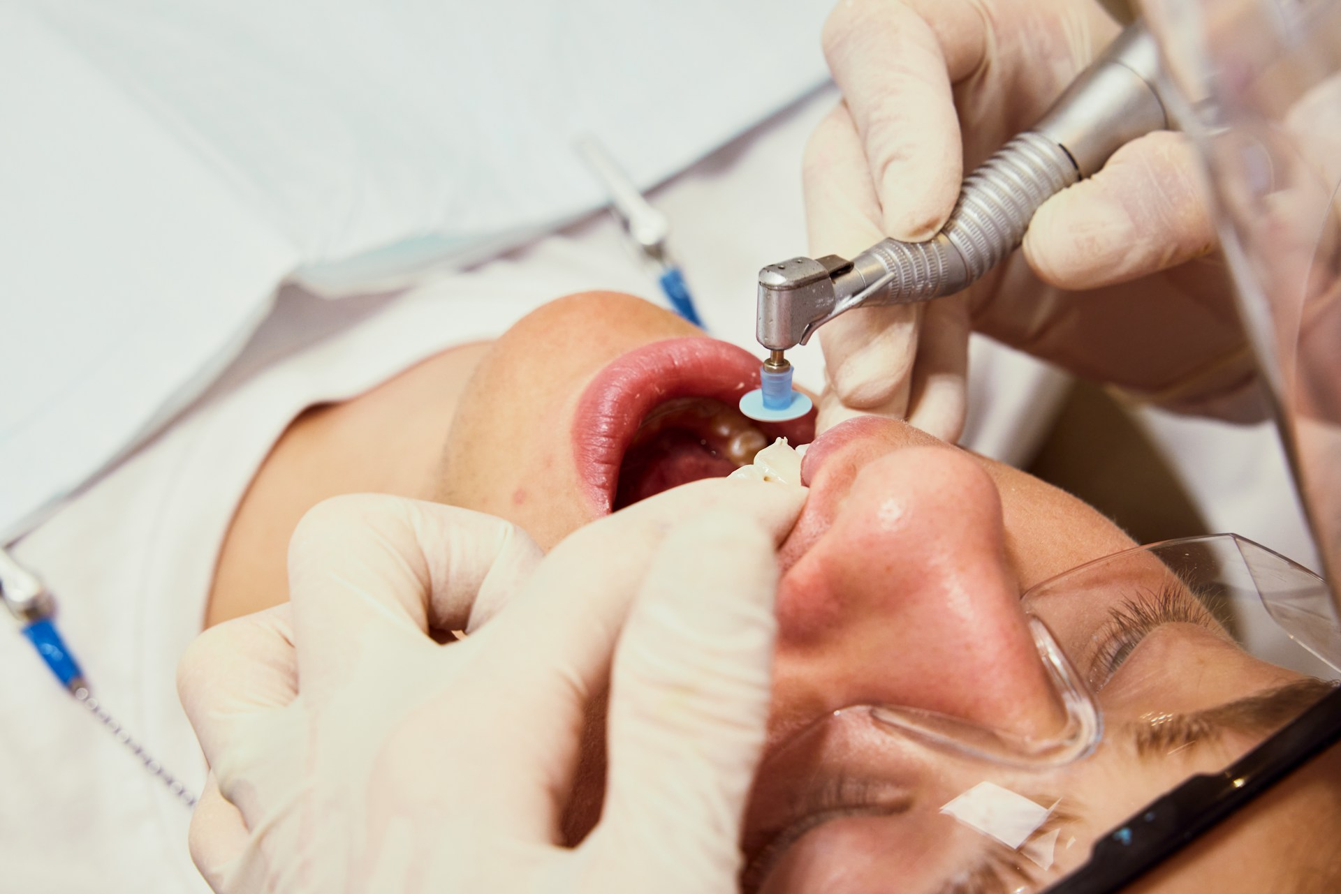 Choosing Dental Implants with Sedation in the Villages