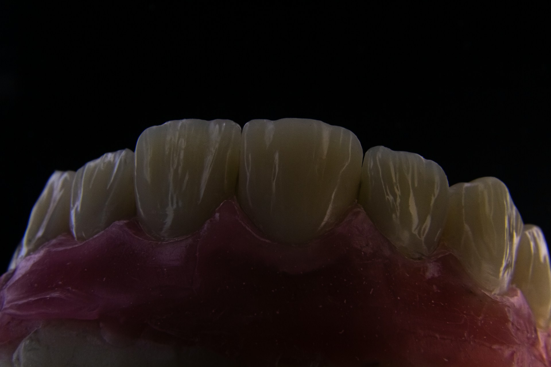 Summer Denture Emergencies in the Villages: Fast Repair Options