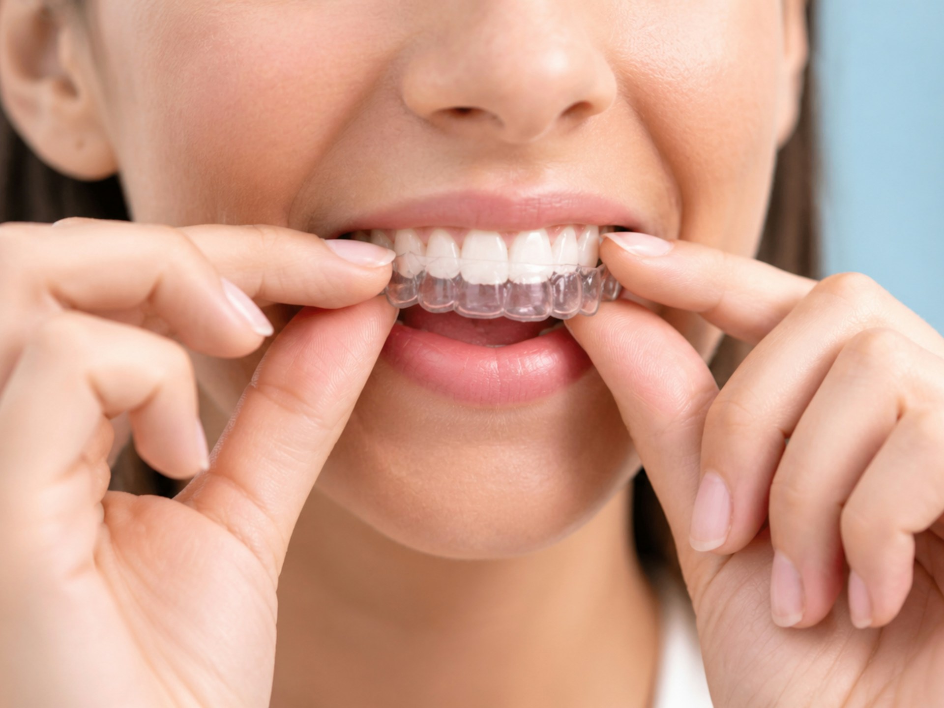 Choosing Clear Aligner Therapy in the Villages with Confidence