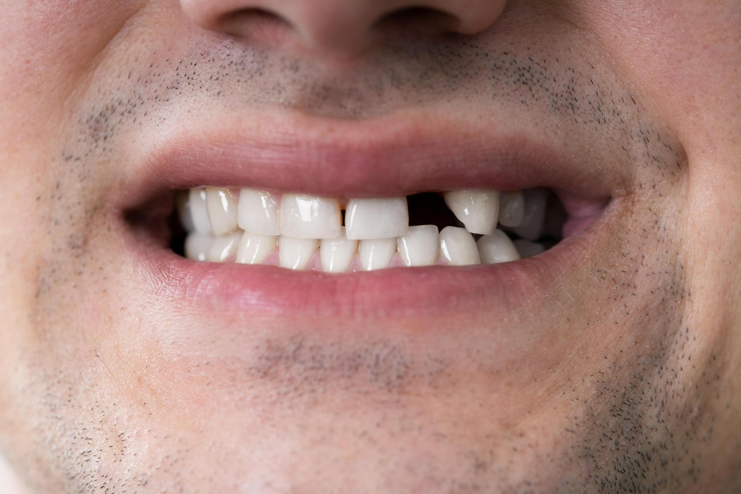 What Affects the Long-Term Cost of Replacing Missing Teeth