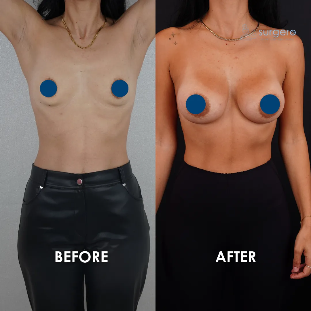 boobjob turkey before and after