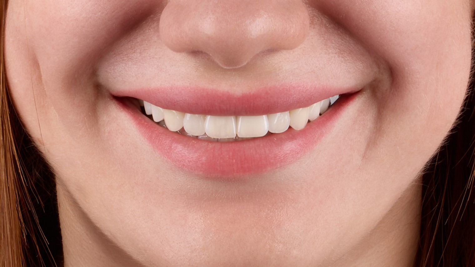 Результат лікування у Sergatiy Dental Clinic: біла рівна усмішка після реставрації зубів

