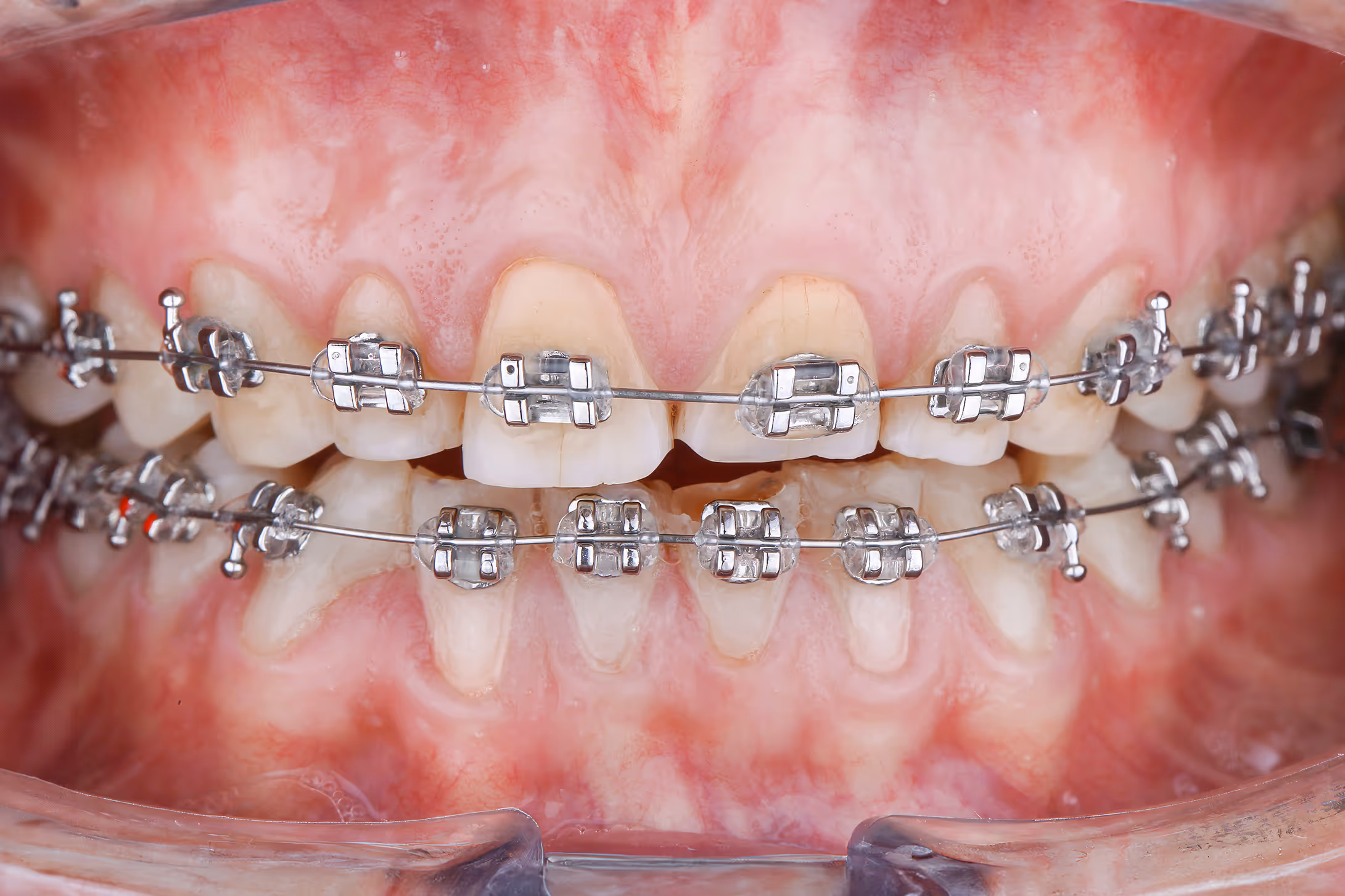 Ортодонтичне лікування за допомогою брекет-системи | Sergatiy Dental Clinic