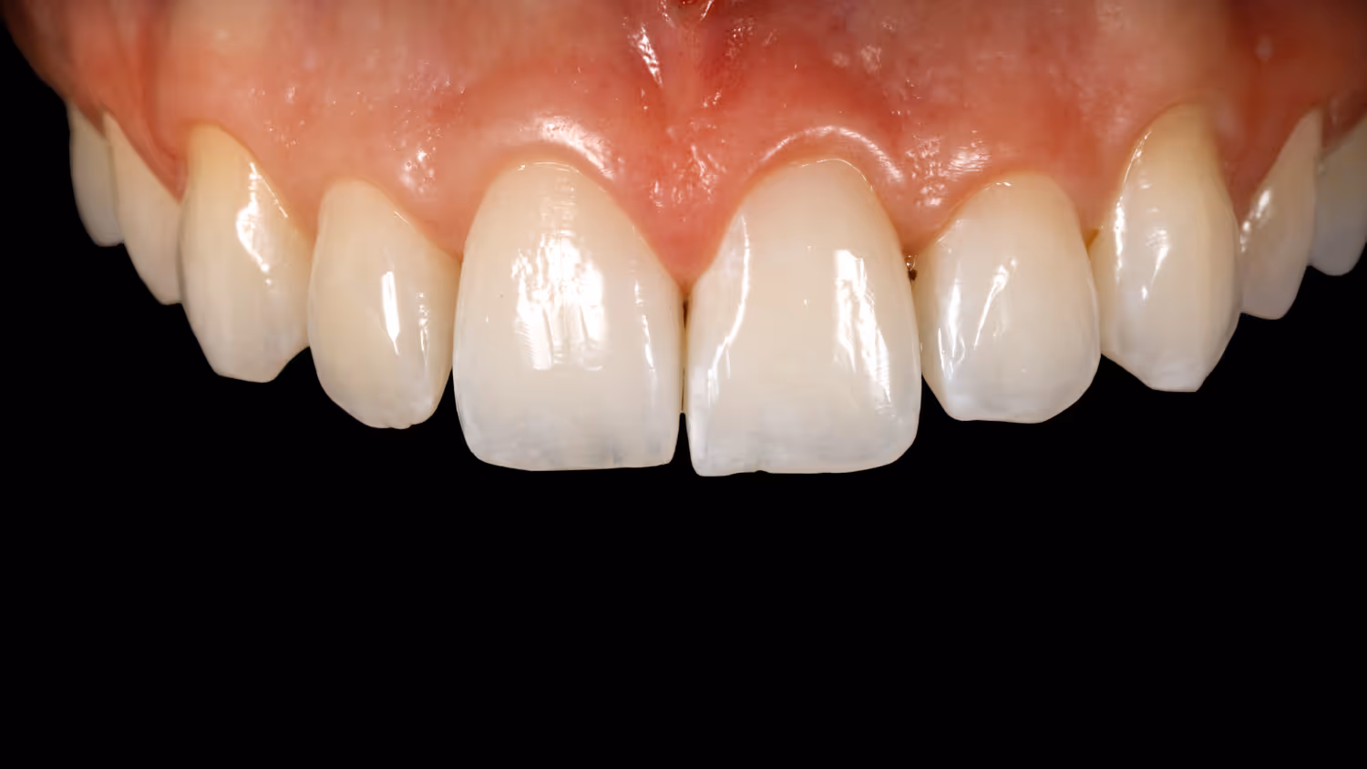 Діагностичний візит. На фото зображення верхні зуби Sergatiy Dental Clinic