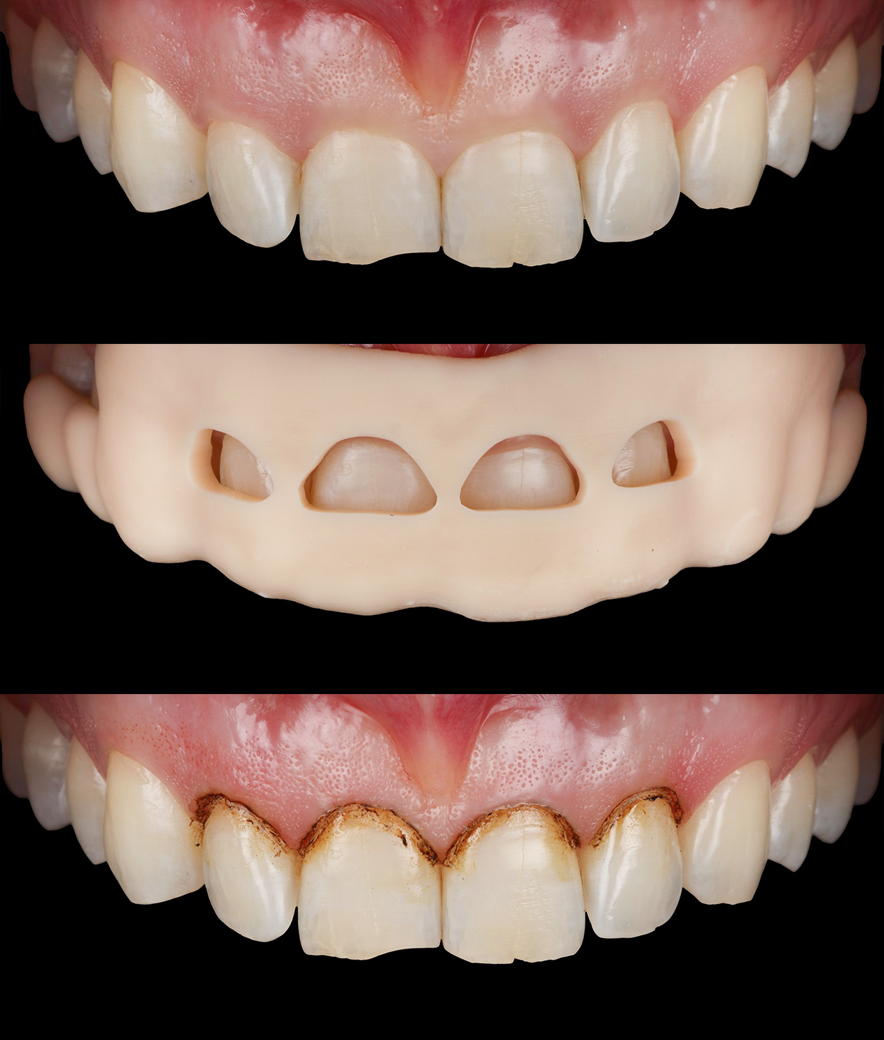 Корекція ясенного контуру для гармонізації усмішки | Sergatiy Dental Clinic