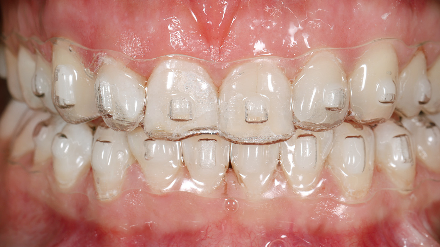 Ортодонтичне лікування на елайнерах перед встановленням вінірів | Sergatiy Dental Clinic
