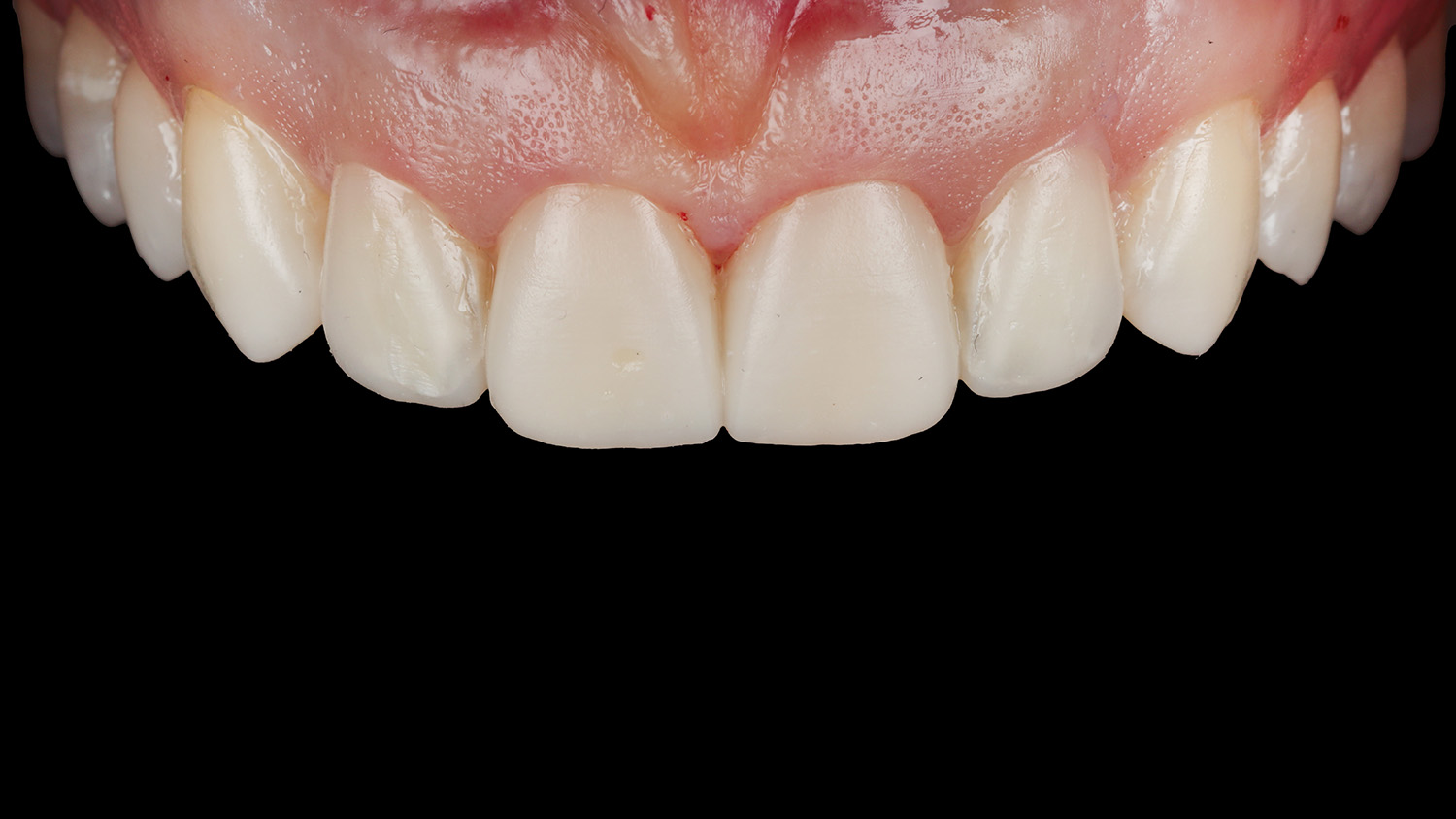 Примірка дизайну усмішки перед постійною реставрацією | Sergatiy Dental Clinic