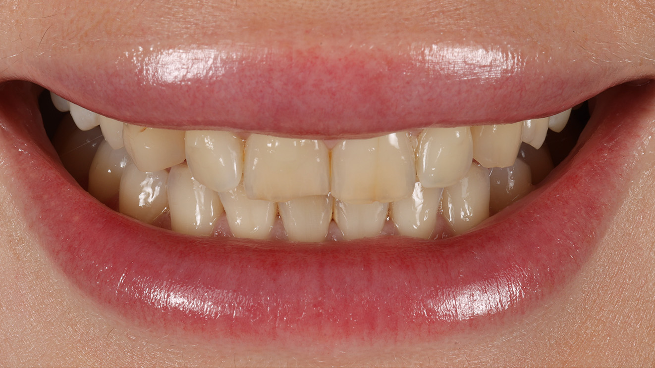 Кейс Альони: усмішка до лікування — нерівні та потемнілі зуби | Sergatiy Dental Clinic