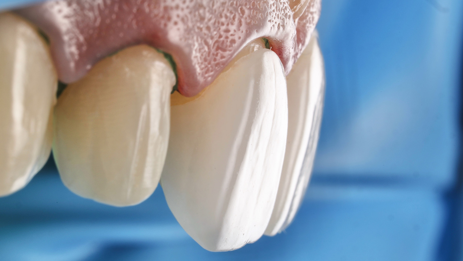 Фіксація керамічних вінірів на зубах пацієнта | Sergatiy Dental Clinic