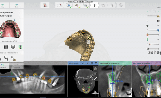 Планування імплантації зубів у Sergatiy Dental Clinic — 3D-моделювання майбутньої посмішки