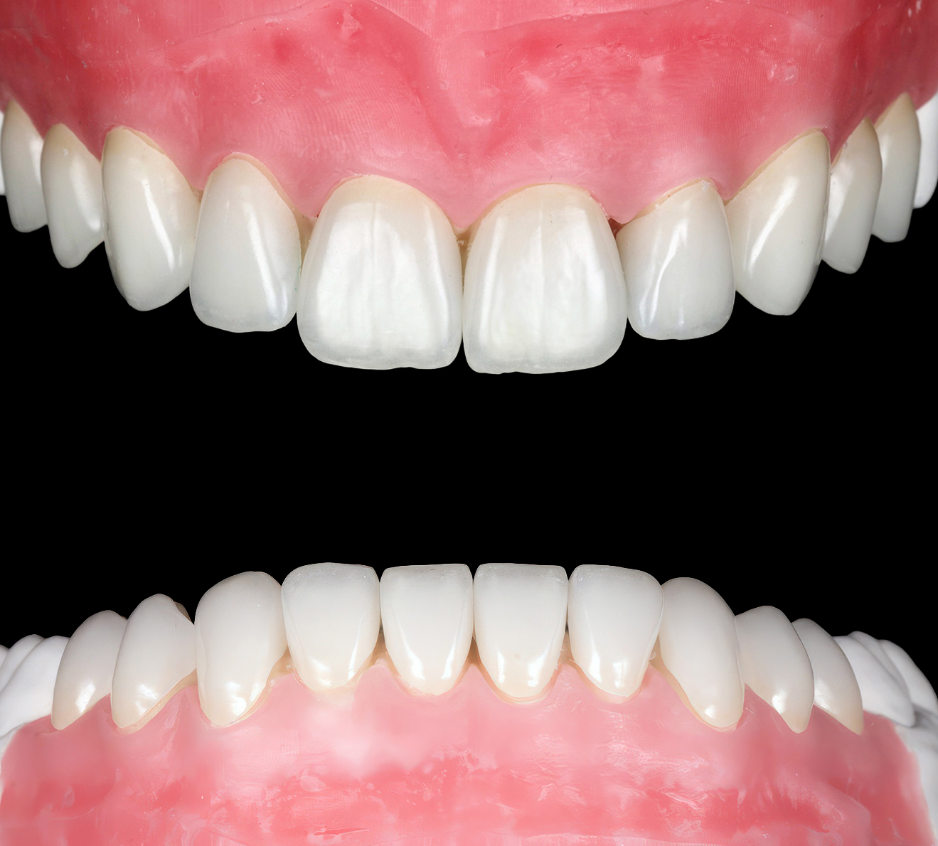 Виготовлення керамічних вінірів у лабораторії на рефракторі | Sergatiy Dental Clinic