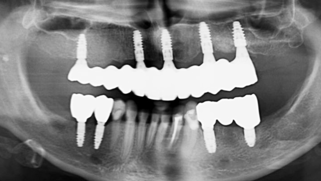 Фінальний рентген — імплантація зубів за методом All-on-X у Sergatiy Dental Clinic