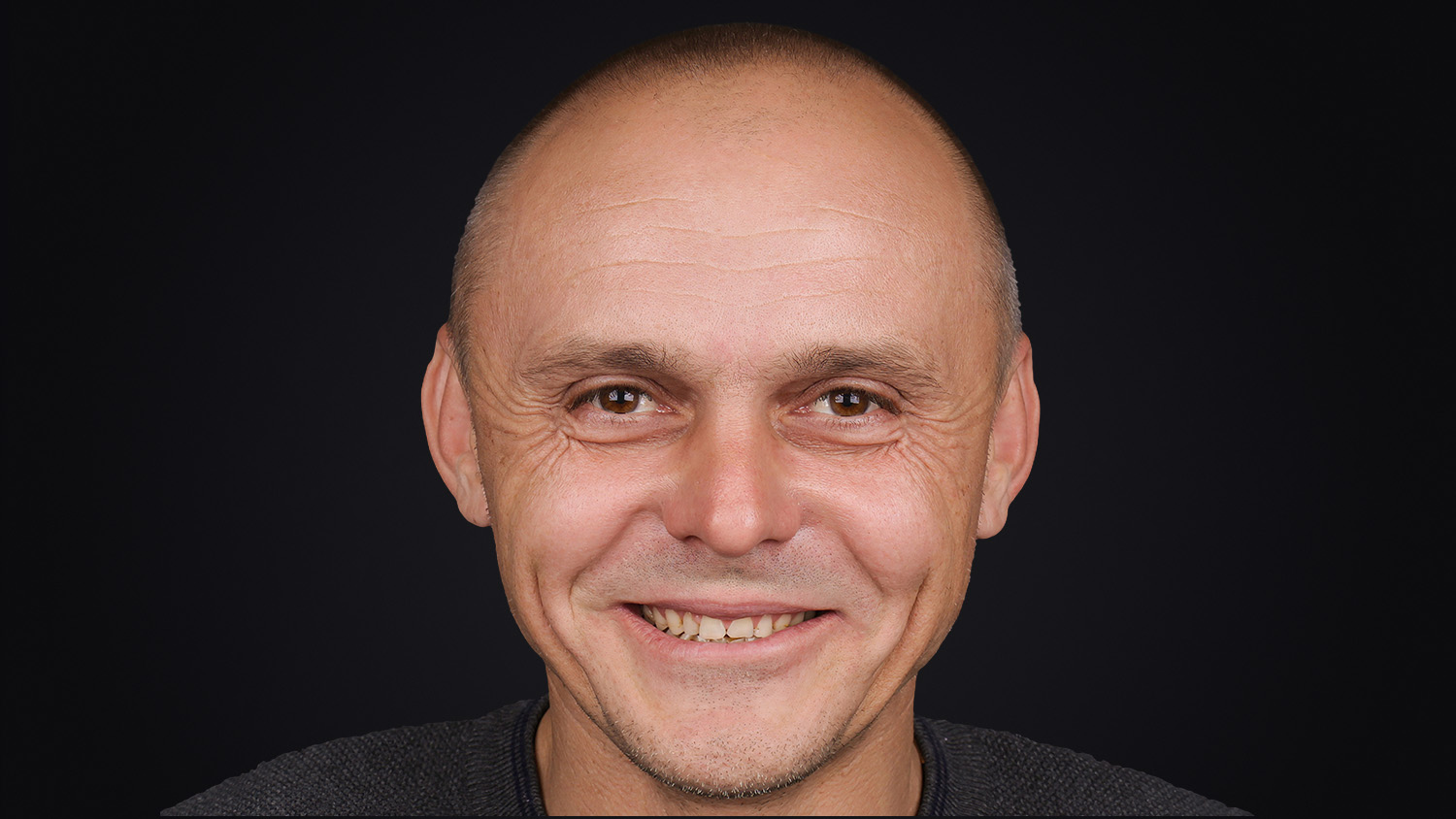 Кейс Сергія: портрет до лікування — усмішка з численними дефектами зубів | Sergatiy Dental Clinic