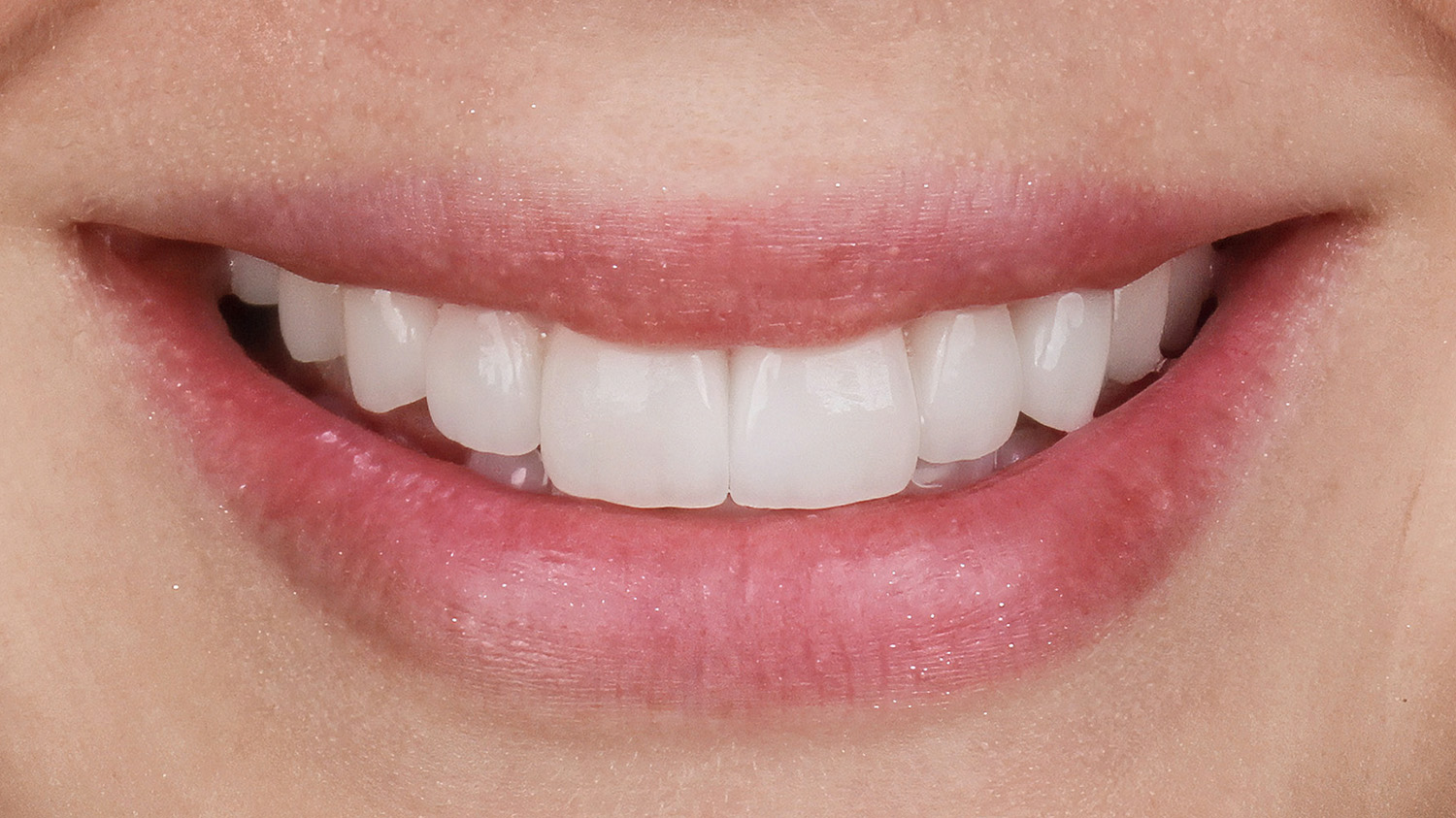 Фінальний результат після лікування в Sergatiy Dental Clinic — білосніжна, гармонійна усмішка з керамічними вінірами.