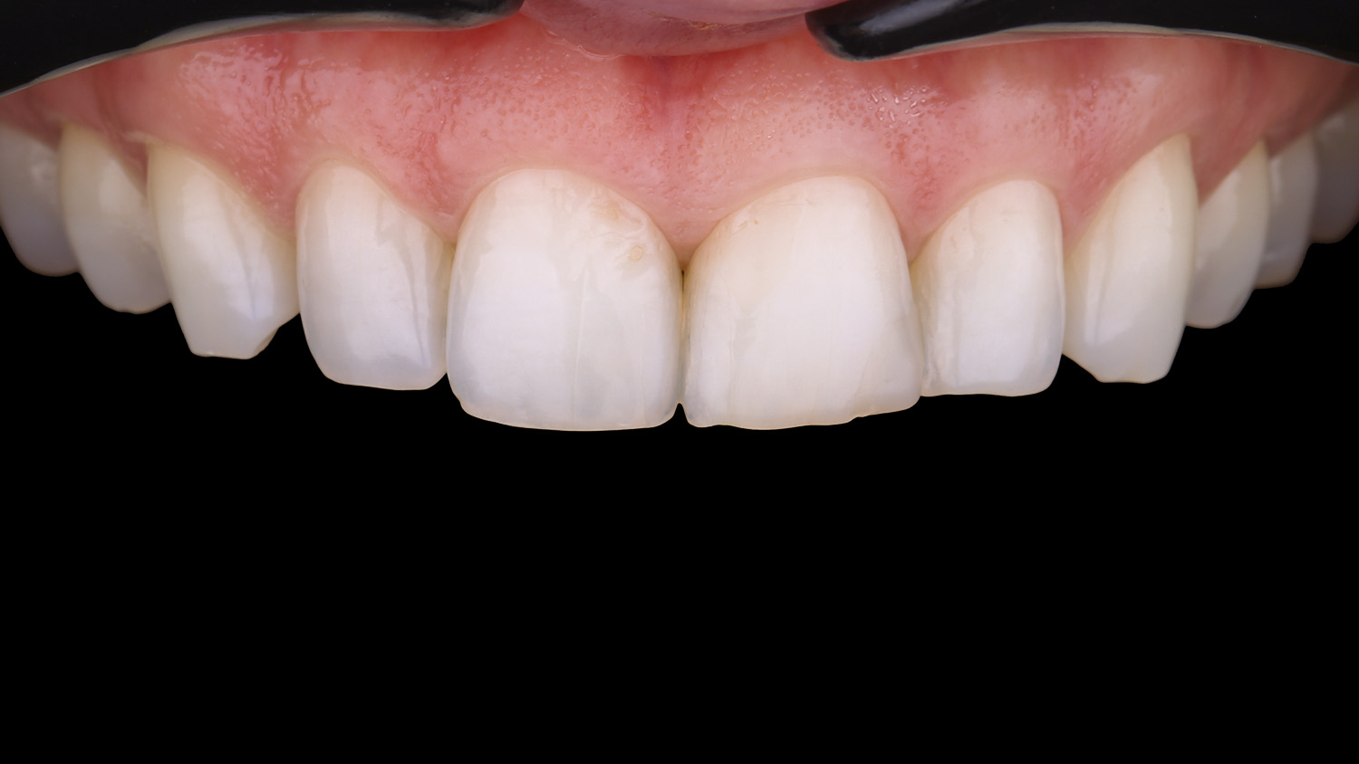 Фронтальні зуби Анжеліки до встановлення вінірів — стертий ріжучий край та темний колір емал