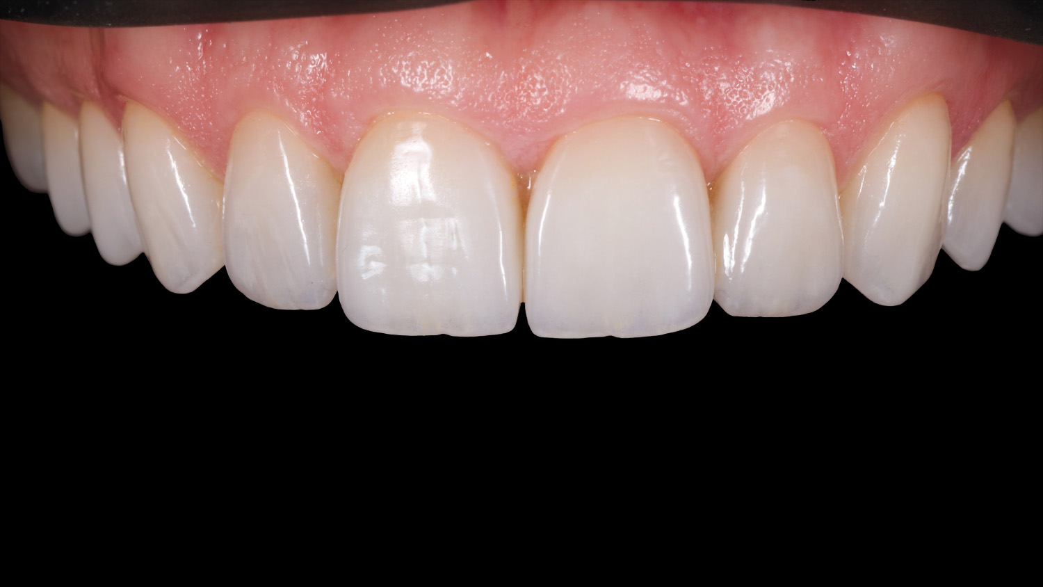 Естетична реставрація фронтальних зубів — натуральні керамічні вініри після лікування в Sergatiy Dental Clinic