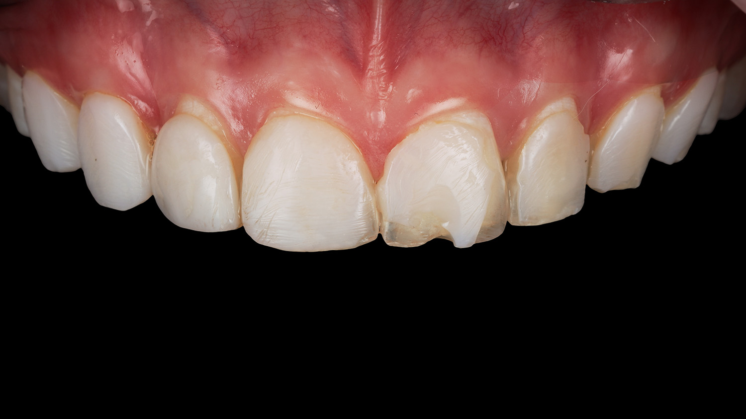 Вид знизу на верхній ряд зубів до лікування лікування — Sergatiy Dental Clinic, Київ
