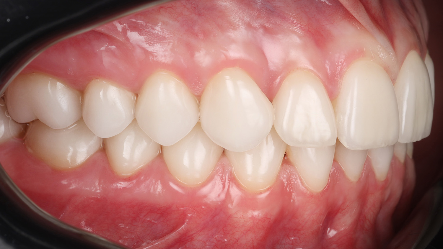 Боковий прикус після лікування — рівні зуби, правильний прикус. Sergatiy Dental Clinic, Київ