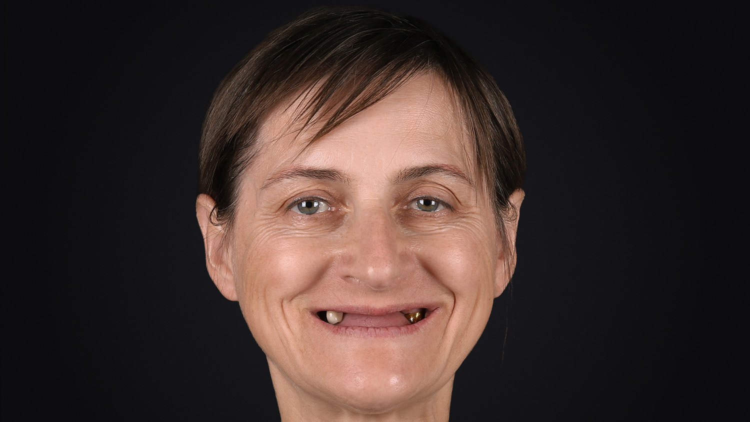 Фронтальний портрет до імплантації в Sergatiy Dental Clinic — втрачена функція та впевненість у собі через відсутність зубів.