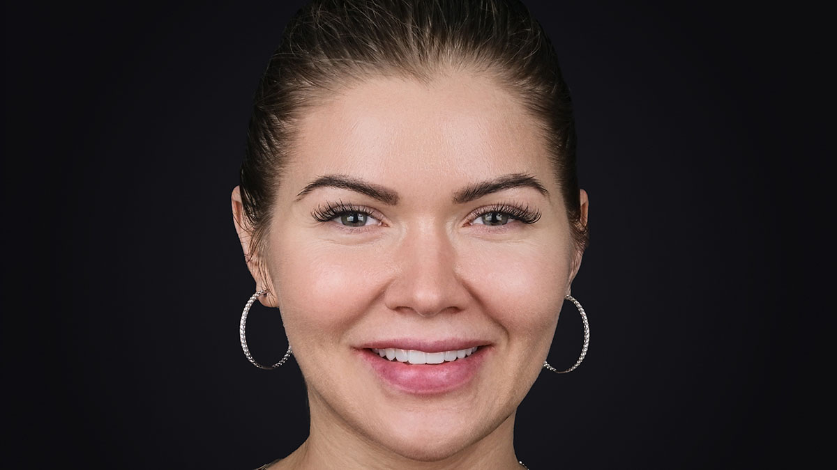 Фінальний результат лікування усмішки Анжеліки — природні вініри в натуральному відтінку, Sergatiy Dental Clinic, Київ