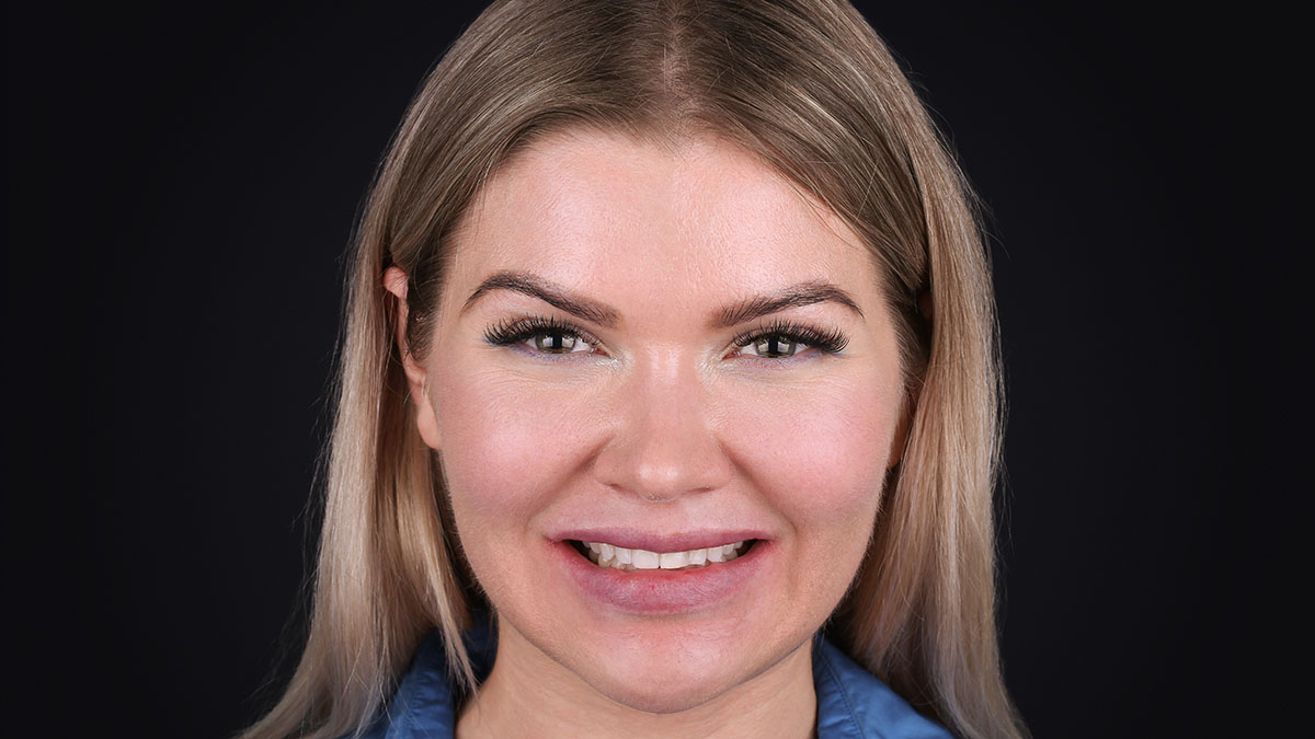 Жінка зі світлим волоссям, усміхається – приклад клінічного результату до/після.